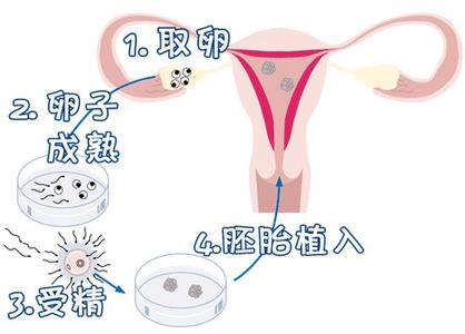 关于志愿者供卵咨询费用多少